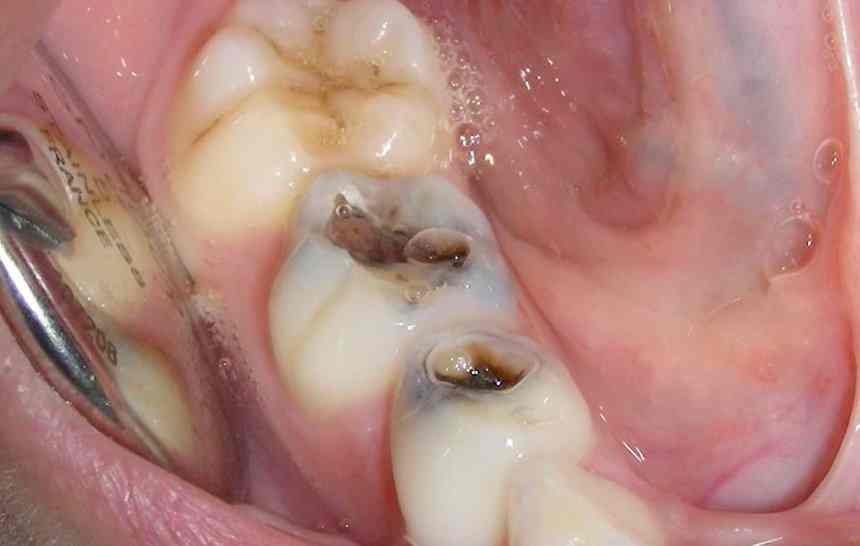 caries-sin-tratar